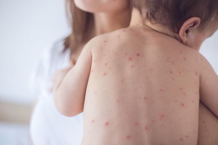 2 mũi vaccine sởi c&oacute; thể ph&ograve;ng được bệnh tới 97%. Ảnh: iStock